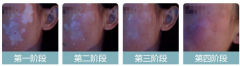 夏季白癜风患者游泳需要注意的