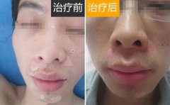 白癜风患者需要注意避免电脑辐