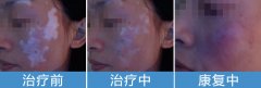 白癜风患者皮肤有时候瘙痒怎么